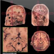 The Head-Navigator shows 3 series of 1cm thick anatomical slices cut in the 3 cardinal planes: Slices from the horizontal and sagittal series are represented in the Atlas