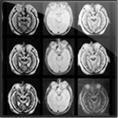 In autopsy brains, relaxation times, signal-to-noise ratio, and contrast are altered due to absence of flow effect, cessation of metabolism and fixation procedures.