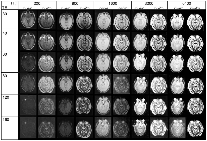 TR and TE (spin-spin relaxation) times for SE sequences. MR images obtai ned under in vivo and in vitroconditions exhibit striking differences. Upper inset (A) shows the plane of sectioning. The lower inset shows every scan overlayed with a grid (A-F) to secure precise location of the same regions of interest throughout the series. (Abbreviations: CP: cerebral peduncle, GM: gray substance), Hi: hippocampus, Li: cerebrospinal fluid, OF: orbital fat, ON: optic nerve, RN: red nucleus, TM: temporalis muscle, VB: vitreous body, WM: white matter.